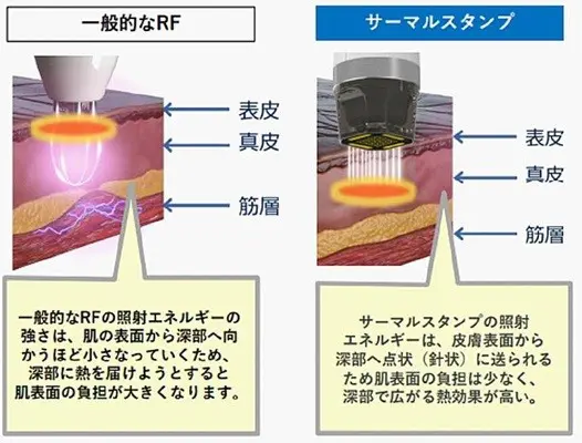 リフトアップ